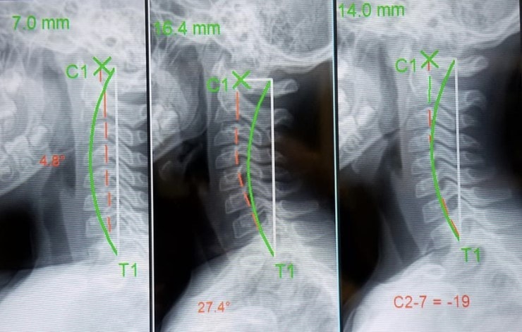 Cervical spine X-ray progression showing before, during, and after neck curve remodeling with Chiropractic Biophysics — demonstrating restoration of natural cervical lordosis